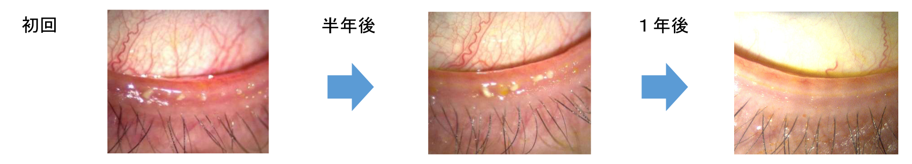 M22でドライアイ治療をした患者様の眼の様子